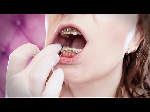 ASMR: upgraded braces with chain-link rubber bands and nitrile gloves (Arya Grander)