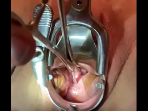Straightening cervical canal with sound tenaculum