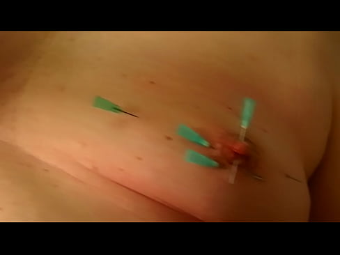 removing nedles from left tit