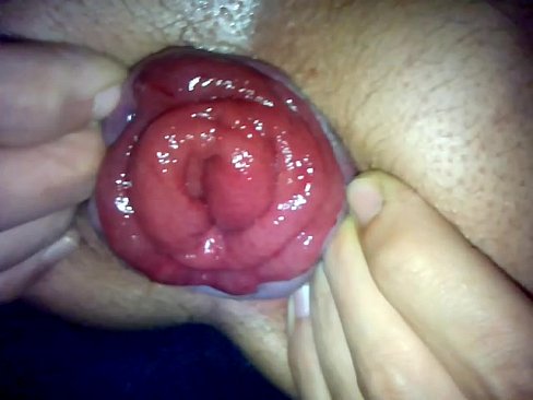 rosebud prolapse