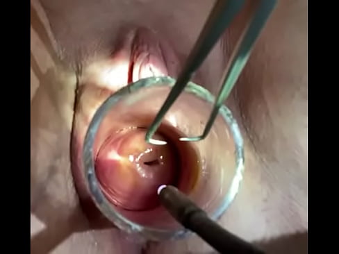 Tenaculum and Hegar dilator through cervix