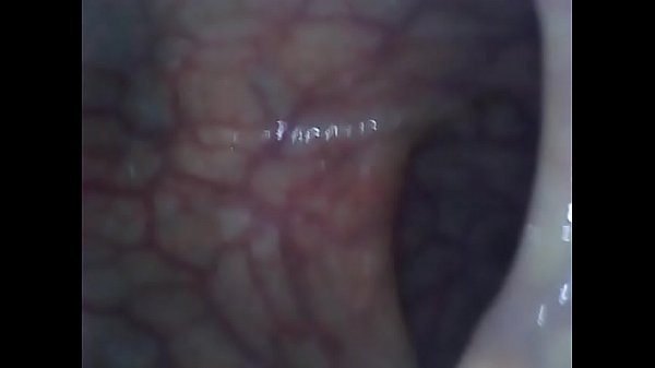 Endoscopy of a tight teen trap