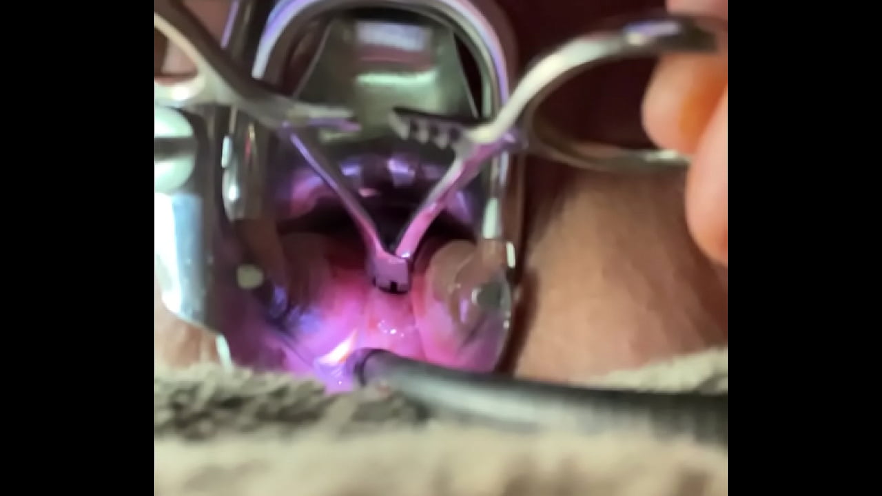 Dilating cervix with hemastats painfully