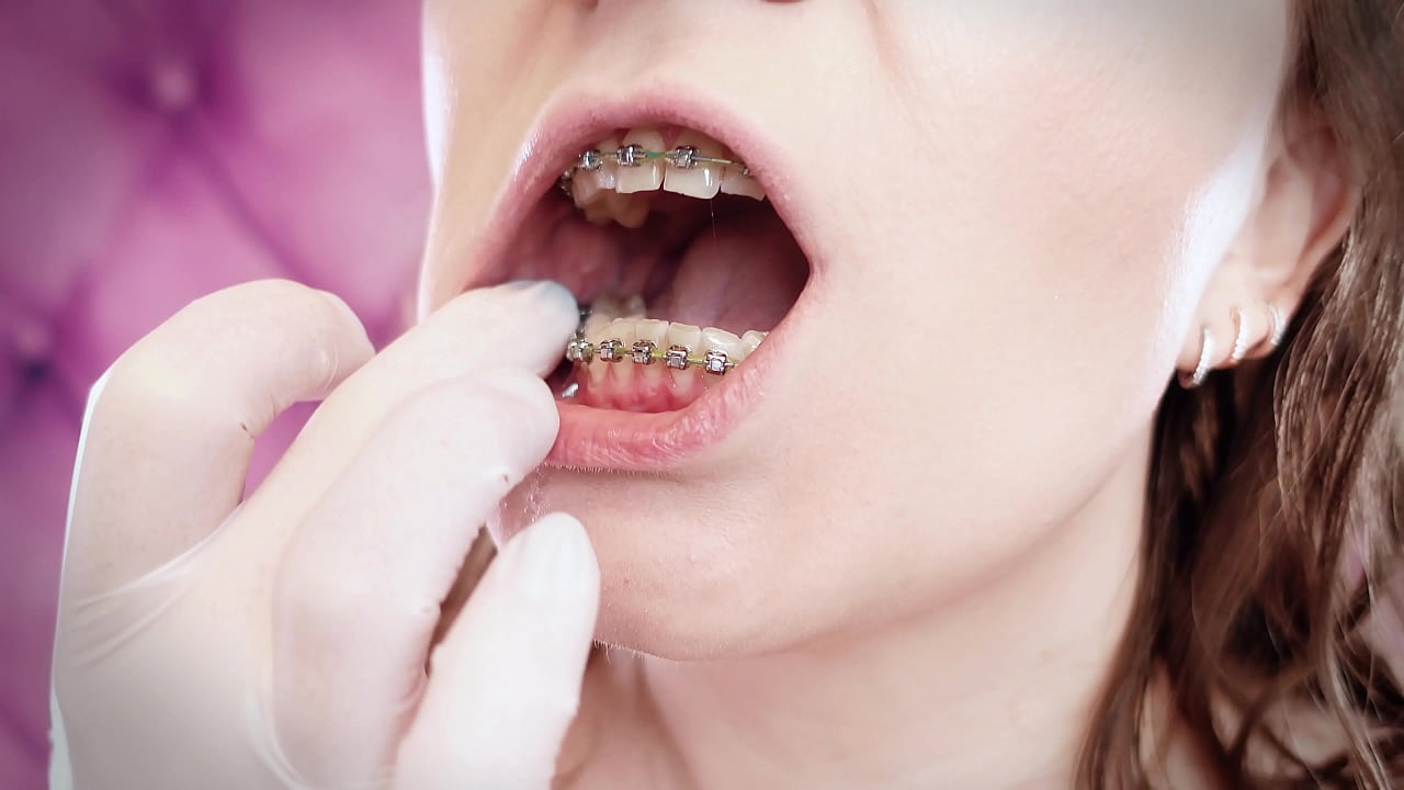 ASMR: upgraded braces with chain-link rubber bands and nitrile gloves (Arya Grander)