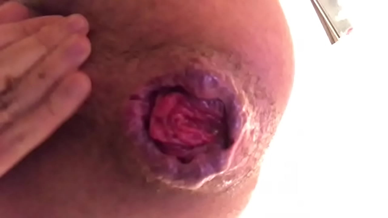 22yo Rosebud Prolapse Cu Arrombado Wrecked Hole Anal Pig Extreme Hardcore Fetish