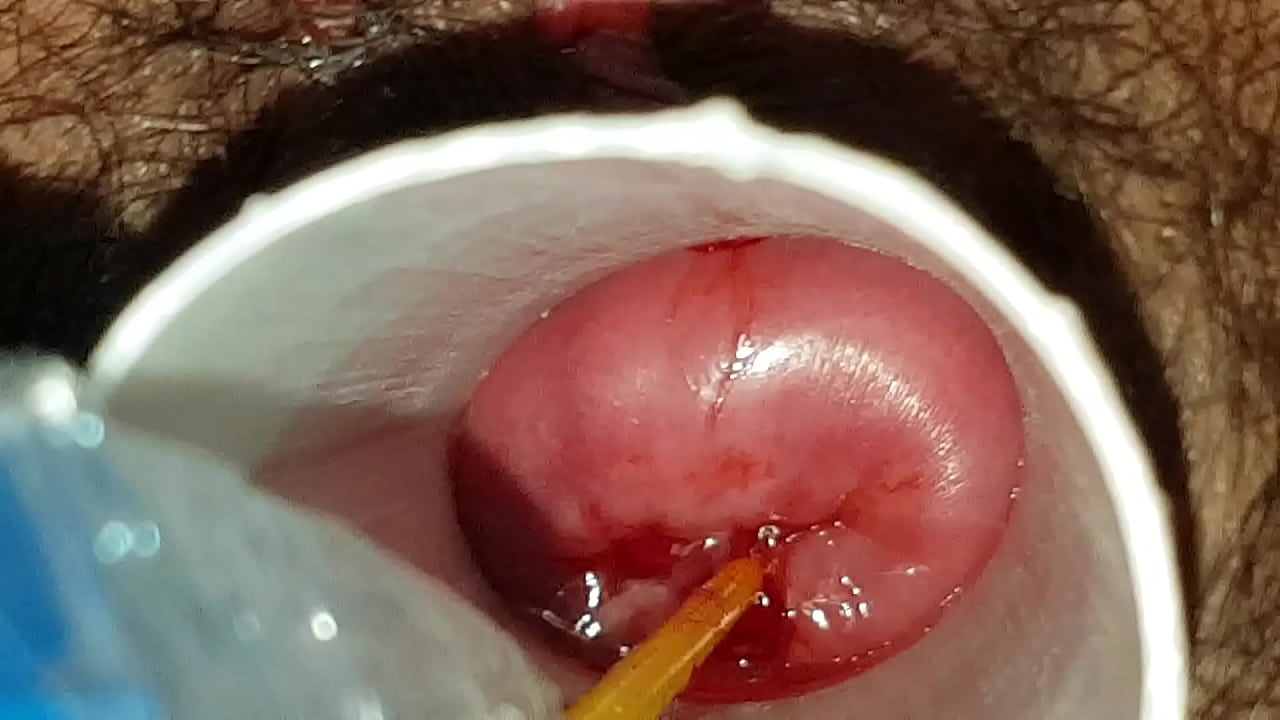 Fucking bogotan cervix 6