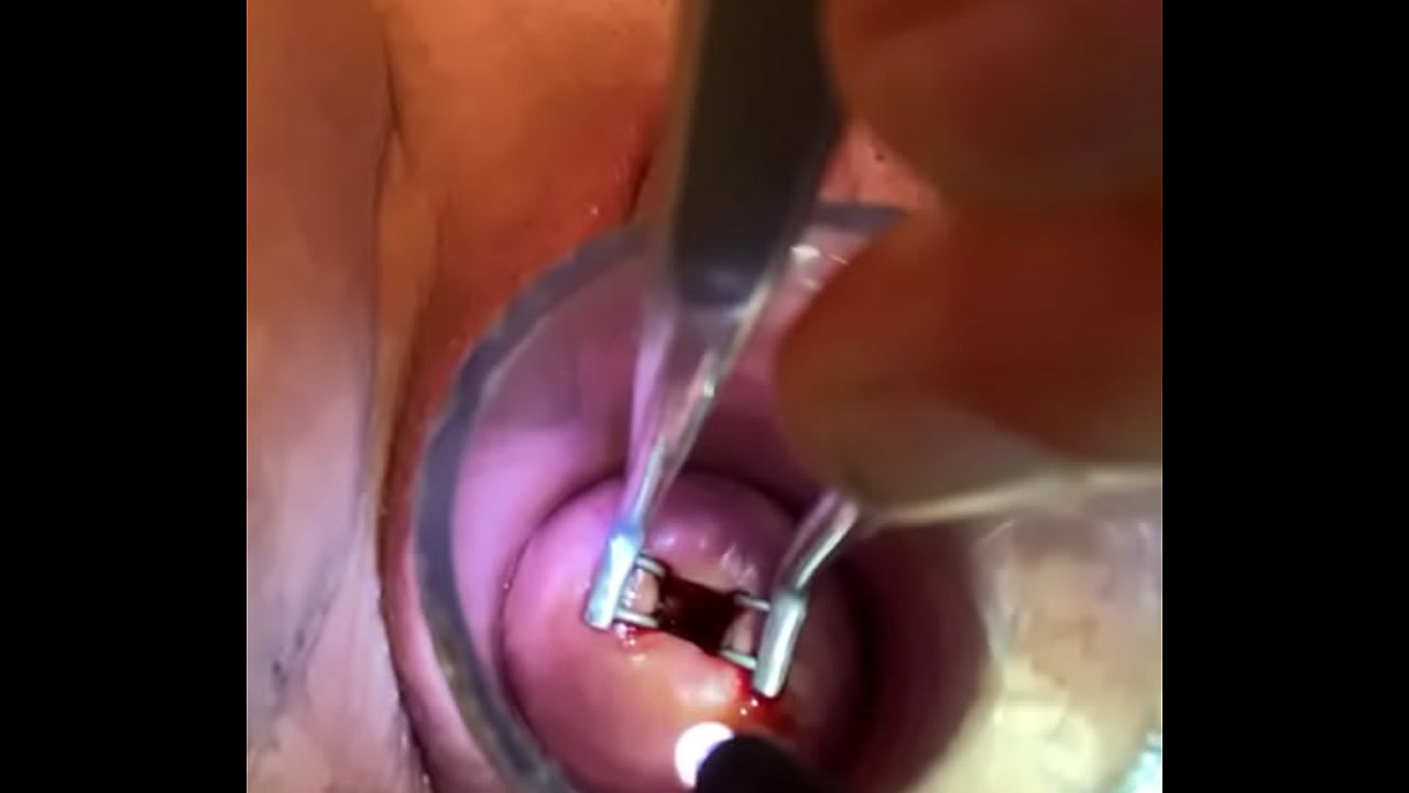 Gyno instrument painfully opens cervix