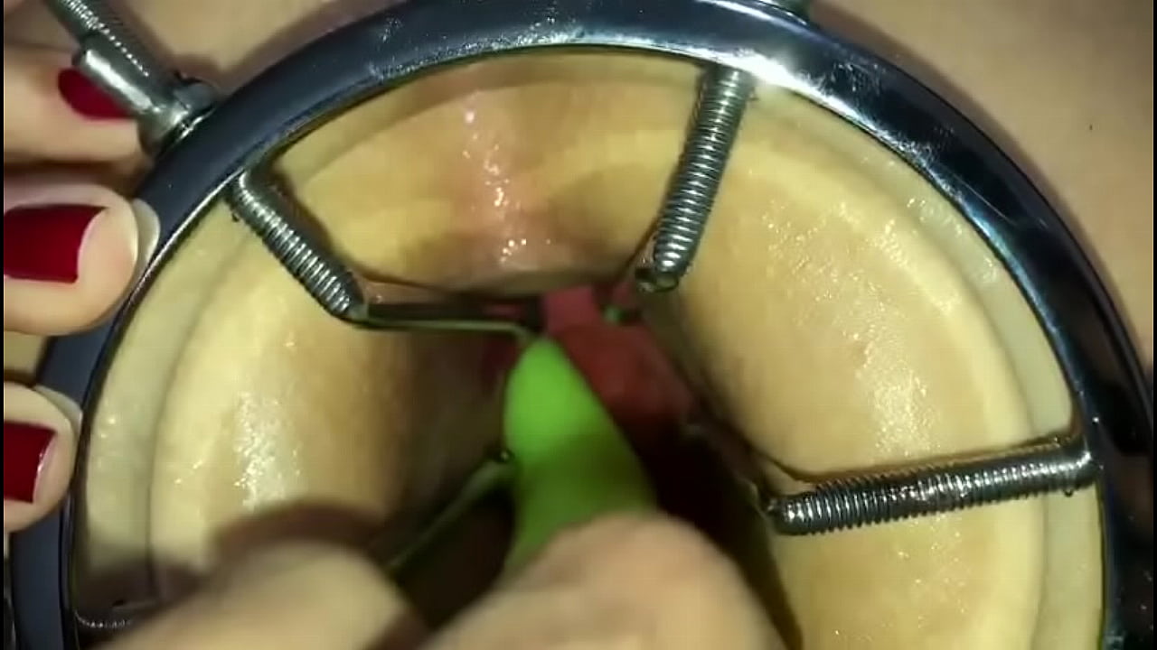 Dilatação anal extrema