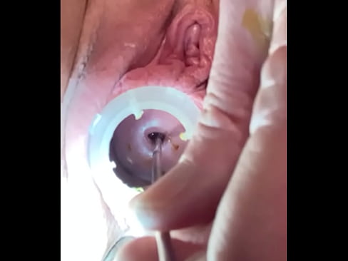 Opening cervix with 4mm sound through internal os