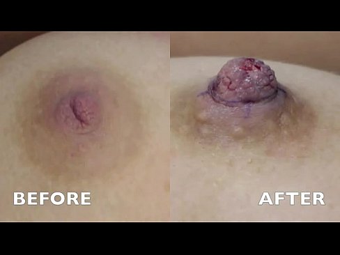 Inverted Nipple Correction - Audio Testimonial   Photos - Aurora Clinics