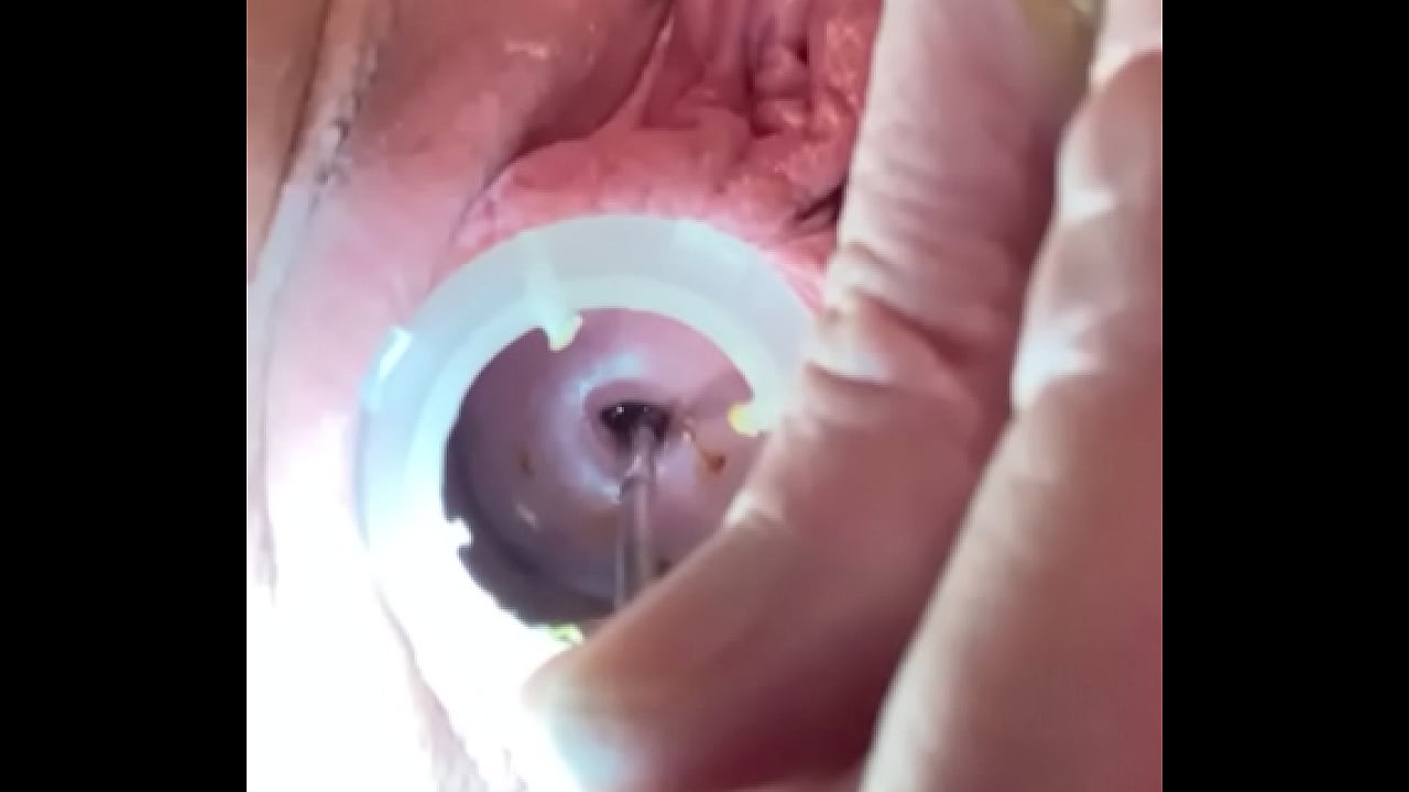 Opening cervix with 4mm sound through internal os