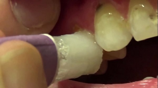 Applying Whitening Paste To Her Filthy Teeth