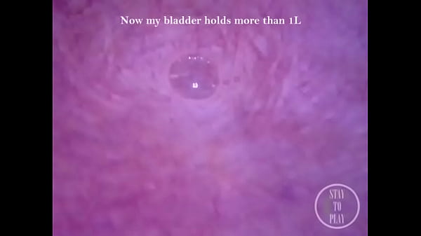 POV Endoscope Catheter Bladder Inflation!