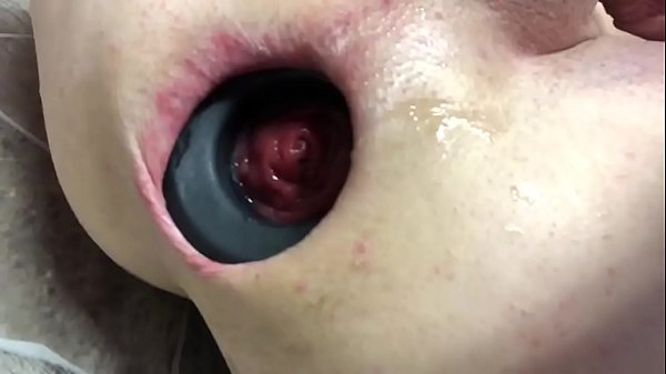 EXTREME ANAL GAPING 1  