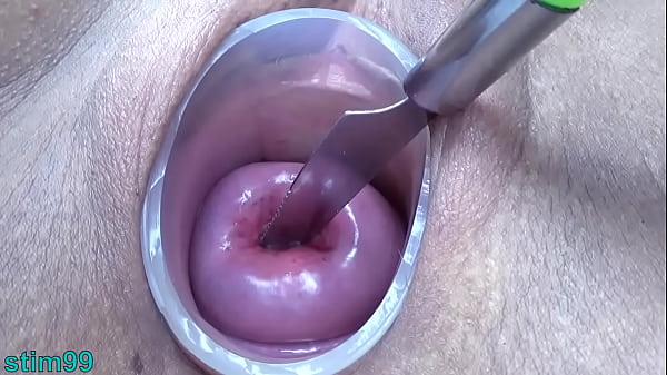 Hot Lesbians get prolapse cervix with catheters inserted into their uterus