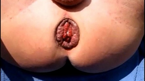 Close Up Anal Ass Anus Dilation Prolapse