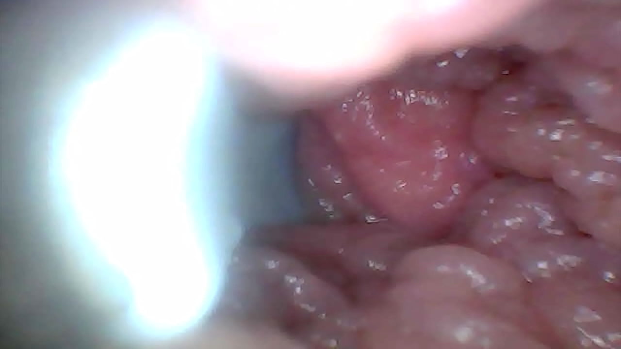 Endoscope camera shows the most sensitive parts of the penis Educational video