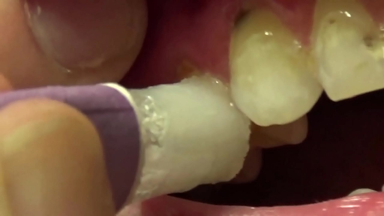 Applying Whitening Paste To Her Filthy Teeth