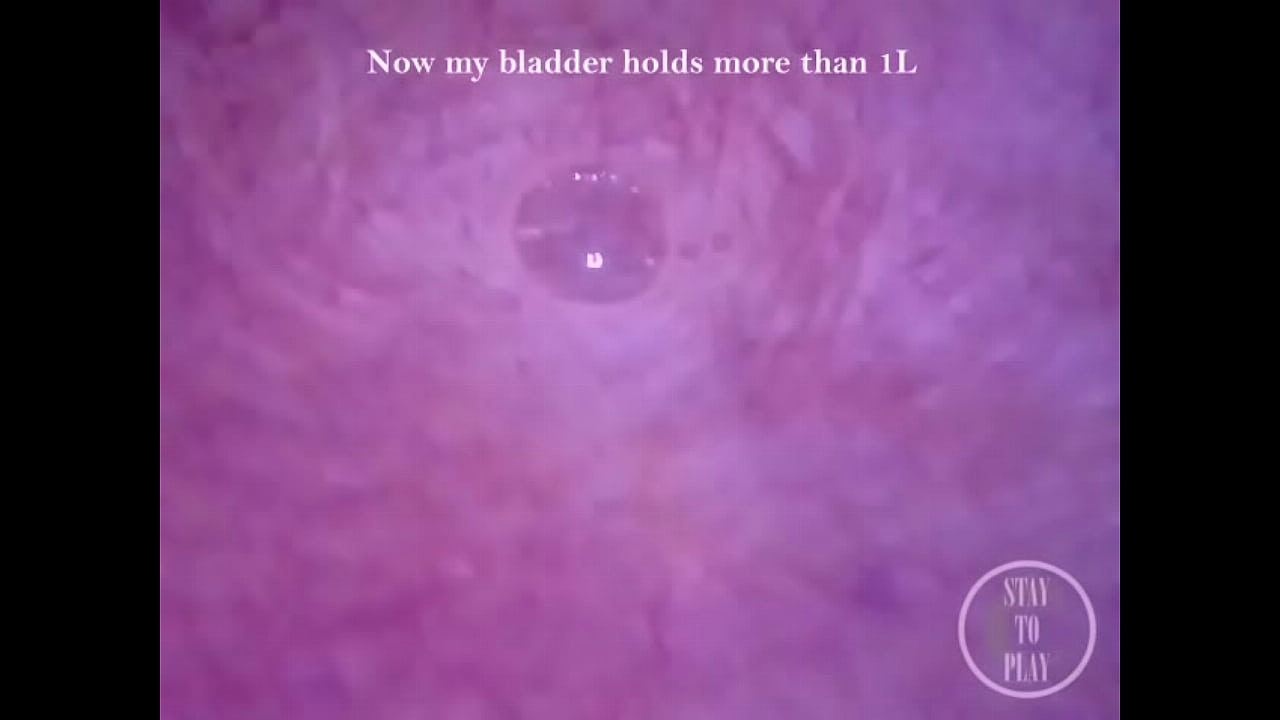 POV Endoscope Catheter Bladder Inflation!