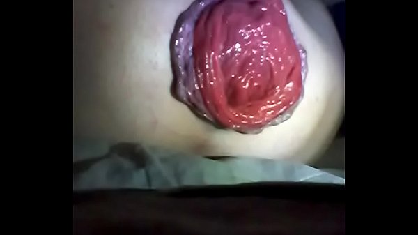 Anal Prolapse