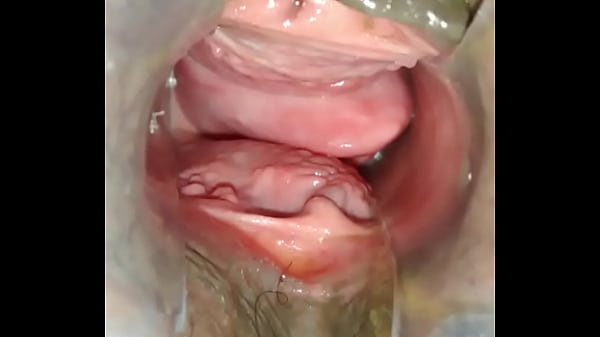 Prolapse vaginal