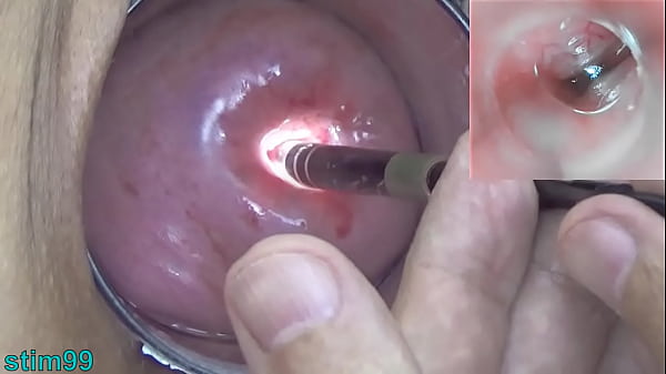Watch inside the uterus of Asian woman with Endoscope camera into Cervix  