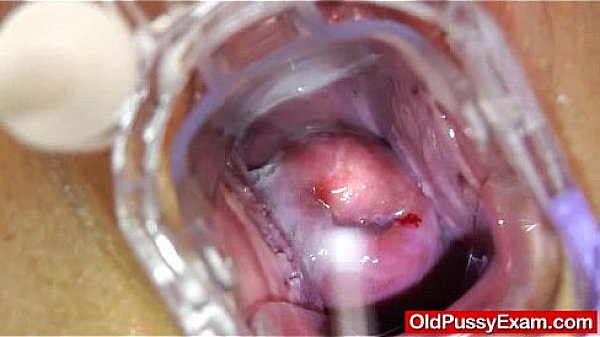 Gyno-tool action during a matured gyno