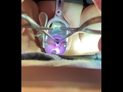 Teeth of tenaculum bite into cervix