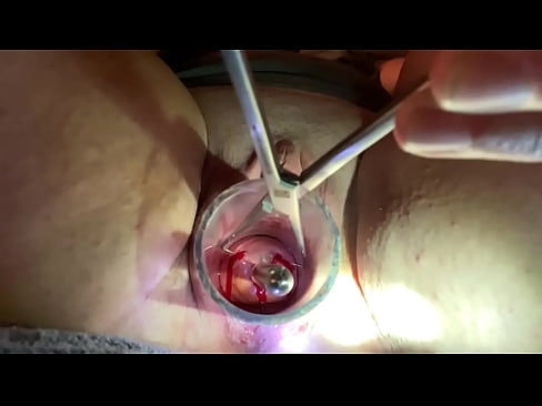 Painful cervix dilation using Tenaculum